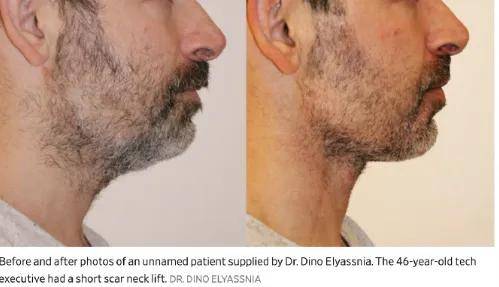 996卷成002后，硅谷科技男为不被裁员扎堆做医美……