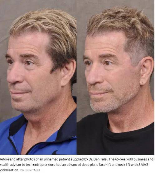 996卷成002后，硅谷科技男为不被裁员扎堆做医美……